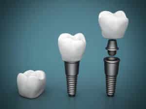 billiga implantat
